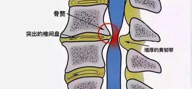 体检查出来有颈椎病怎么办(体检颈椎有问题怎么办)