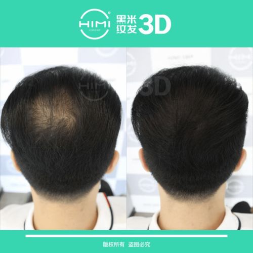 黑米3D纹发 脱发人群的心路历程,你都度过哪几个