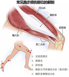 康复知识 髂胫束摩擦综合征