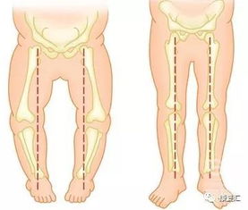 O型腿矫正方法盘点,都在这里了 