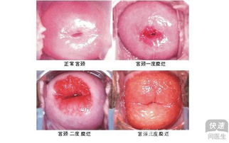 治疗宫颈糜烂的偏方