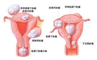 子宫肌瘤对怀孕会产生哪些影响