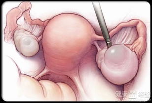 卵巢囊肿怎么办 右侧卵巢囊肿怎么办