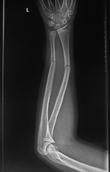 弹性髓内钉治疗儿童尺桡骨双骨折一例