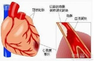 心肌梗死手术后会出现什么情况(心肌梗死术后有什么症状)