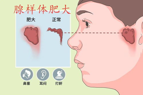 贵阳铭仁耳鼻喉医院 警惕 孩子越长越丑 快看你家的孩子是不是腺样体面容