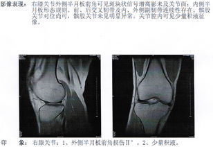 膝盖半月板被撞伤