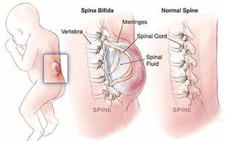 脊柱裂能不治疗吗 