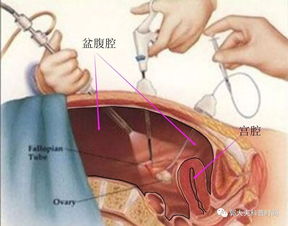 妇科手术的路径与微创 关于子宫切除的小秘密 二 