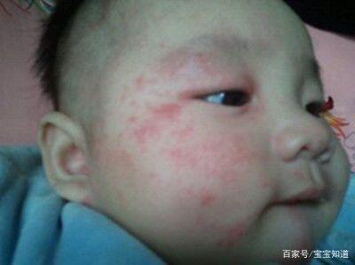 婴儿脸上湿疹怎么办,护理与专业治疗双管齐下