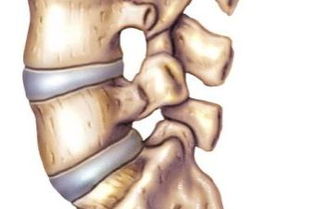 腰椎骨质增生压迫神经引起腿疼,行走困难,怎么治效果... 