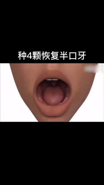 种4颗牙恢复半口牙 