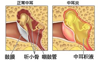 中耳炎该怎么办呢