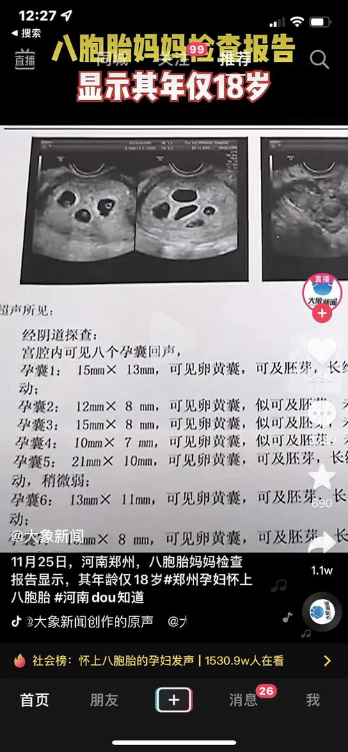 郑州孕妇怀上八胞胎(多胎妊娠有多危险你知道吗)