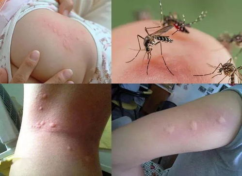 蚊子咬了眼睛几天会退 被蚊子咬了眼睛又痒又疼又肿怎么办？ 