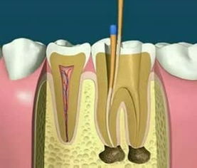 讲解一下牙齿根管治疗 