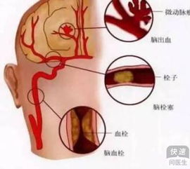 脑梗塞防止复发要注意戒烟戒酒 脑梗塞的临床症状