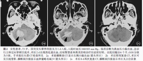 肝脓肿穿刺引流术护理