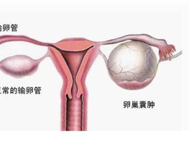 卵巢疾病 卵巢病变的症状有哪些