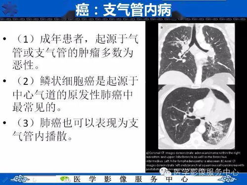 肺癌的影像学鉴别诊断实例 哪些不是肺癌