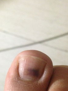 我的脚大拇指指甲上面不知怎么搞的有一大块紫黑色 严重吗 