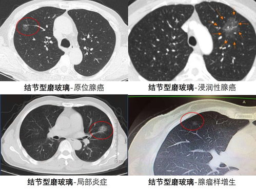 磨玻璃结节是什么原因造成的 类型有哪些