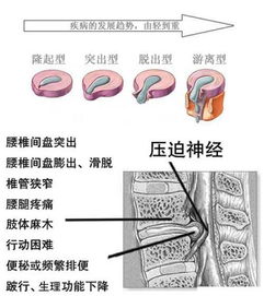 我有轻微腰椎间盘突出，许氏节节突出，针灸有用吗(轻度腰椎间盘突出针灸)