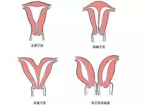 已婚女子三年未孕原来是纵隔子宫 南华医院妇科专家轻松解忧