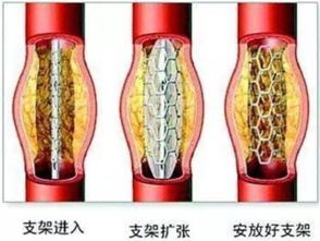 冠状动脉狭窄到底要不要做支架 看心脏病专家怎么说