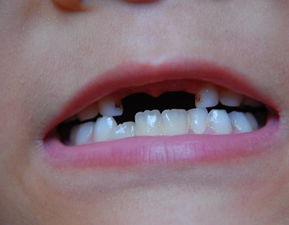 牙齿缺失怎么办 用什么方法修复牙齿缺失呢