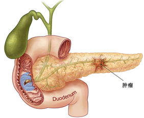 中医专家谈中医对抗胰腺癌晚期 延长生命 