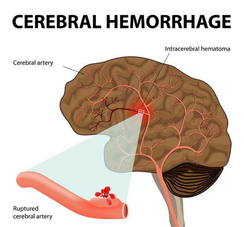 发生脑出血,就治不好了 这个回答,让人由忧转喜