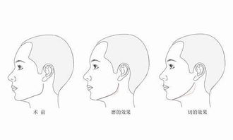 去掉土味宽下颌角,成功化身高级 电影脸