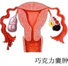 卵巢巧克力囊肿能怀孕吗？巧克力囊肿,能怀孕吗