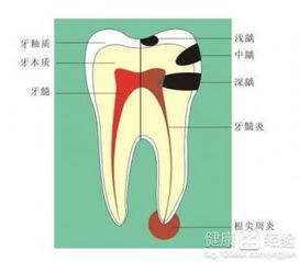 儿童牙髓炎吃什么药