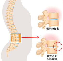 骨质增生偏方