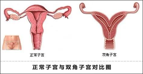 子宫畸形有六种情况,有的直接影响你怀孕