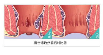 痔疮痛怎么办缓解疼痛