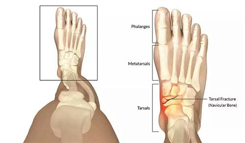 足舟骨骨折 搜狗图片搜索