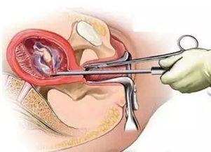 医生,您觉得哪个好 论药物流产与人工流产孰优孰劣