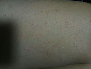 为什么我的小腿大腿一到冬天就痒 这是什么皮肤病 