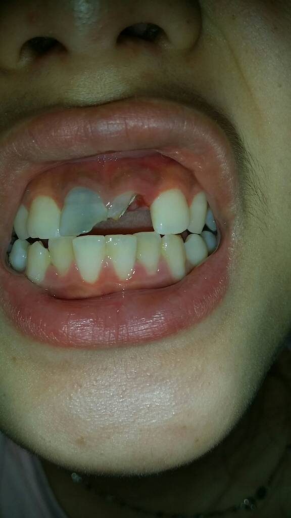 我前面两颗门牙5年前撞坏了,现在想搞全瓷牙,问过医生是1500一颗,两颗都撞掉一小块,现在牙齿是黑 