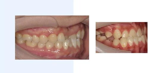 Dr.舒广矫正病例,牙齿反颌戴托槽还是隐形牙套