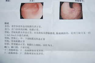 胃镜显示贲门高位反转未见异常,是不是证明贲门没有松弛 