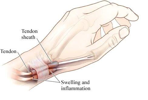 手指腱鞘炎症状与治疗