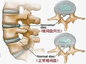 怎么区分腰椎间盘突出症和腰椎管狭窄 掌握这两点马上就明白 