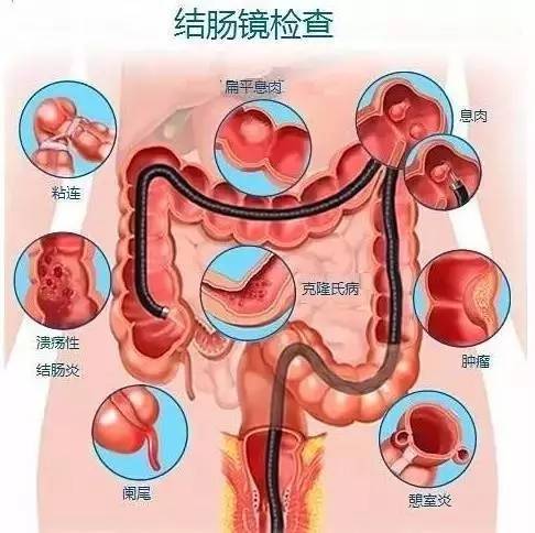 肠镜检查后需要注意哪些饮食和生活习惯？