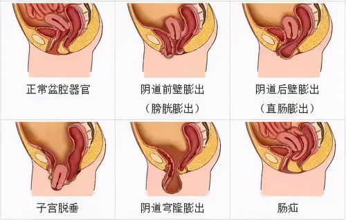 慌了 子宫 肠子 膀胱 都可能 掉出来 这七类女性需注意