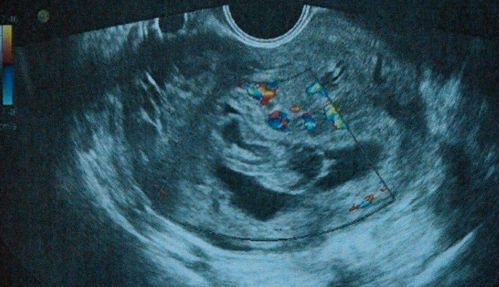孕早期，做阴超会影响胎儿？易流产？