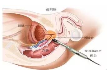 前列腺癌患者应该知道的那些事儿